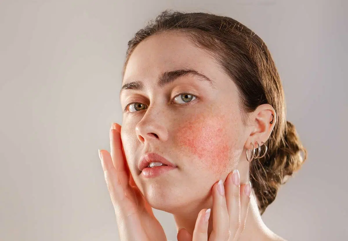 Rosacea Awareness Month